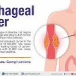 Understanding and Preventing Esophageal Cancer