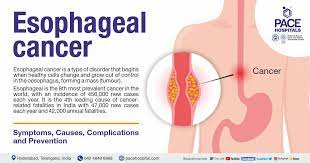 Understanding and Preventing Esophageal Cancer