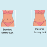 reverse tummy tuck for breast volume