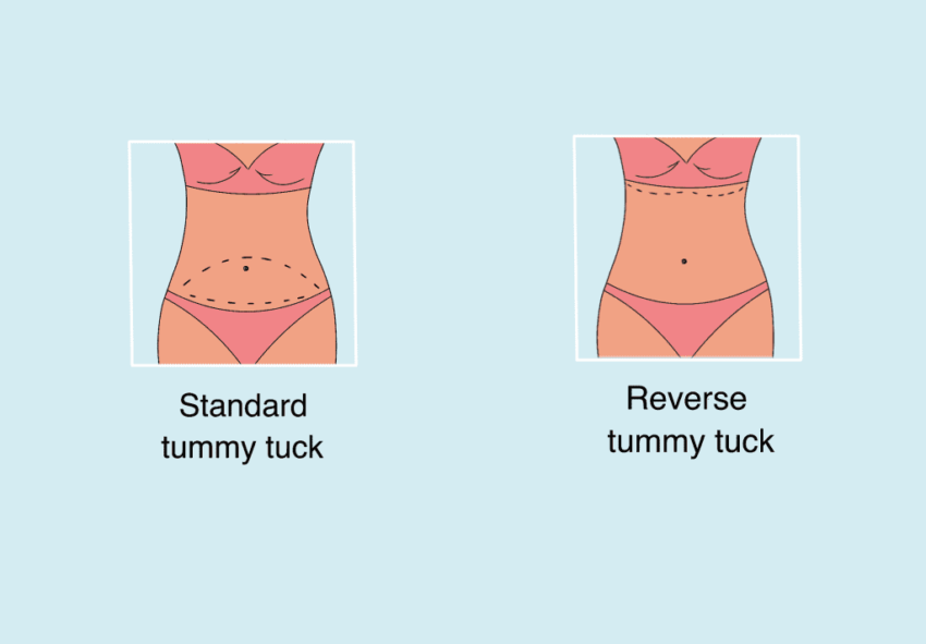 reverse tummy tuck for breast volume
