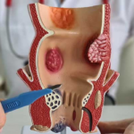 Colon Surgery Specialist