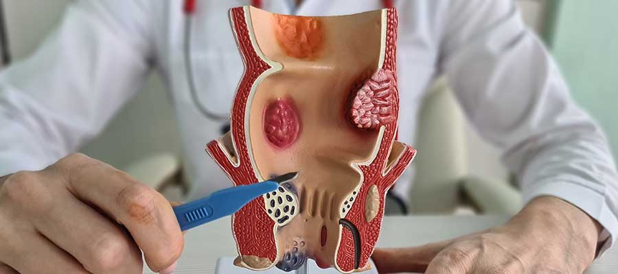 Colon Surgery Specialist